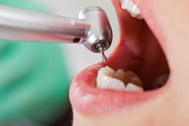 Best Emergency Wisdom Teeth Removal in Charenton, LA